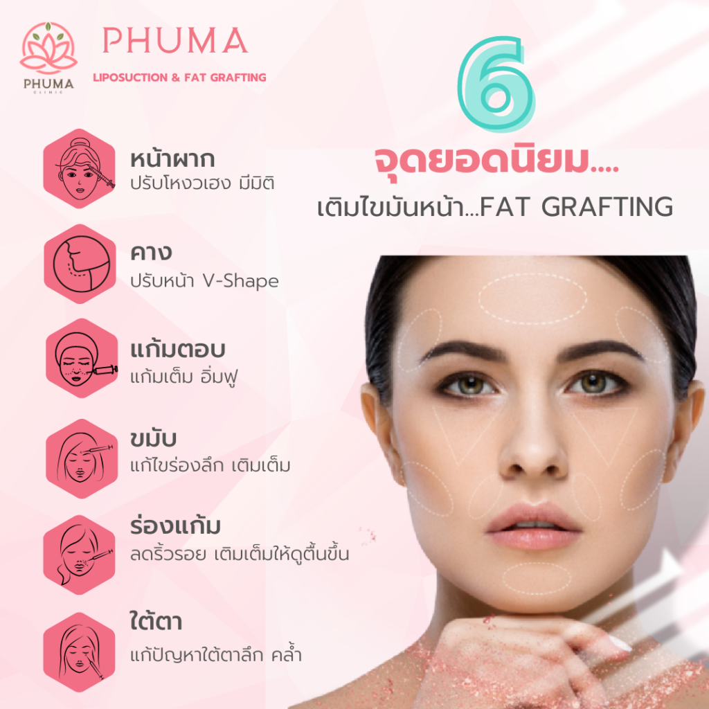 6 จุดที่นิยมเติมไขมันหน้า คุณหมอหนูใหม่ Phuma clinic