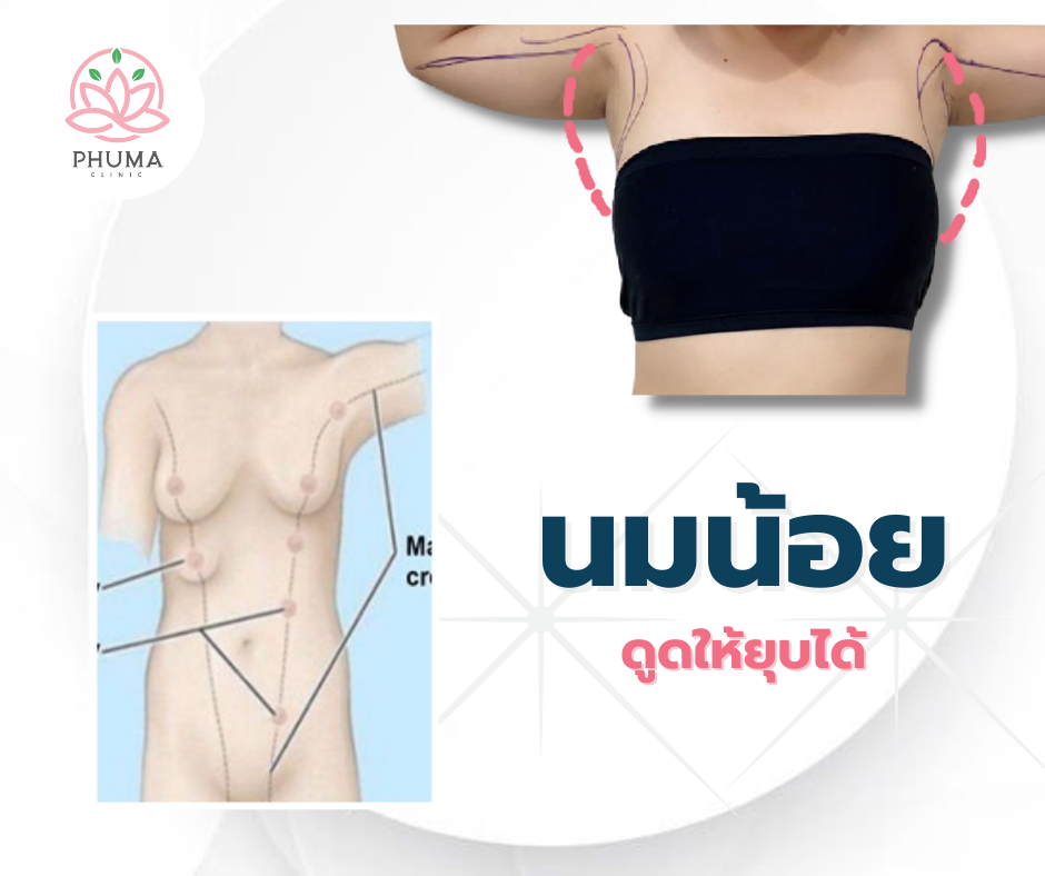 ดูดไขมันนมน้อย หมอลดา (คุณหมอหนูใหม่) phuma clinic