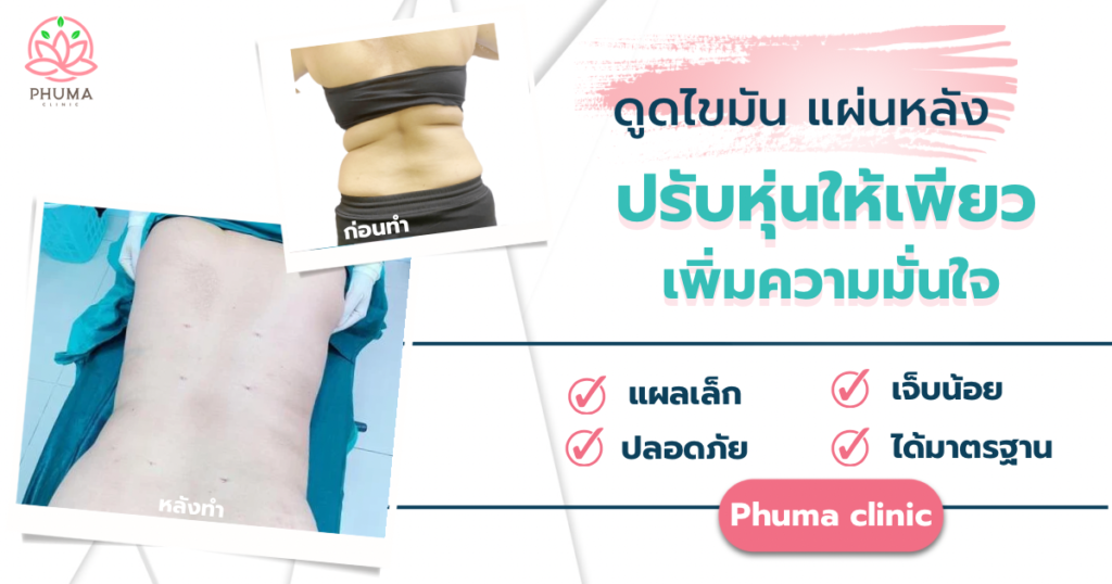ดูดไขมันแผ่นหลัง คุณหมอหนูใหม่ phuma clinic
