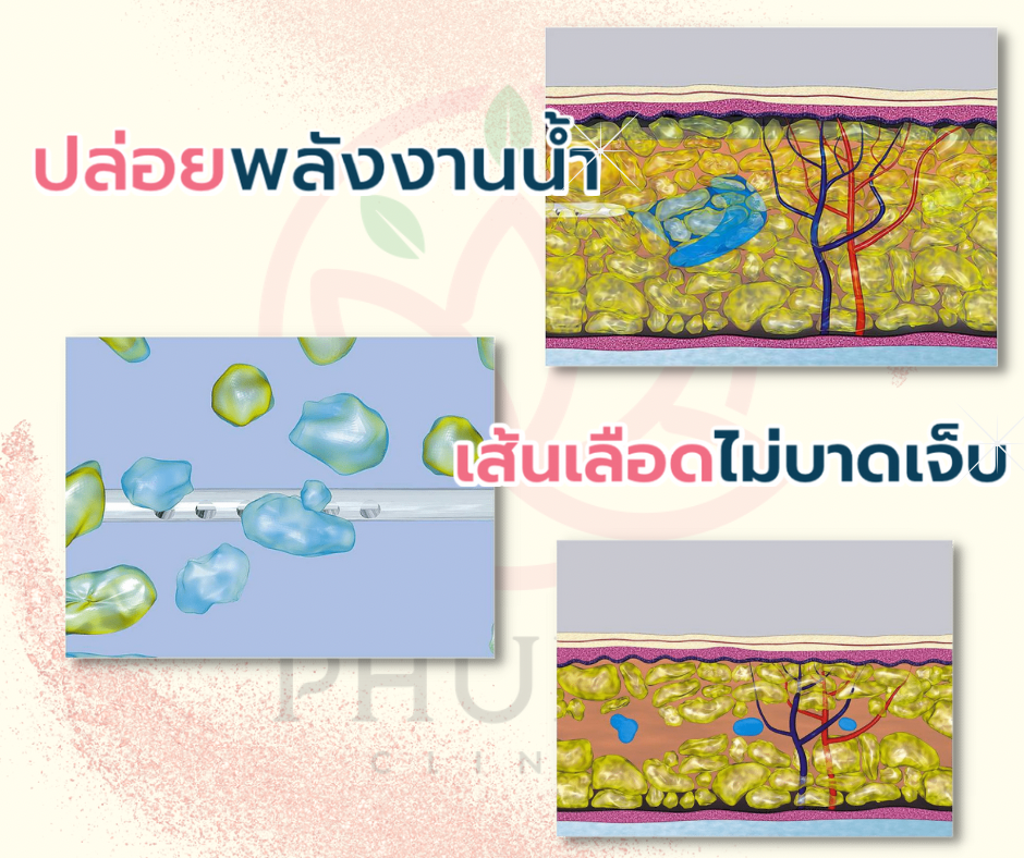 เครื่องดูดไขมันพลังงานน้ำ หมอลดา (หมอหนูใหม่) Phuma clinic