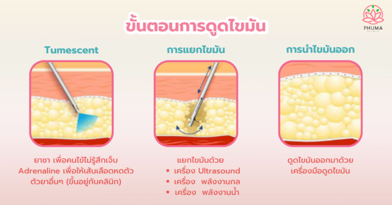 ขั้นตอนการดูดไขมัน