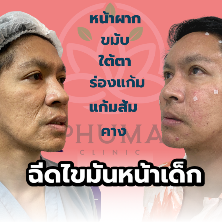 เติมไขมันหน้าเด็ก หมอลดา (คุณหมอหนูใหม่) phuma clinic