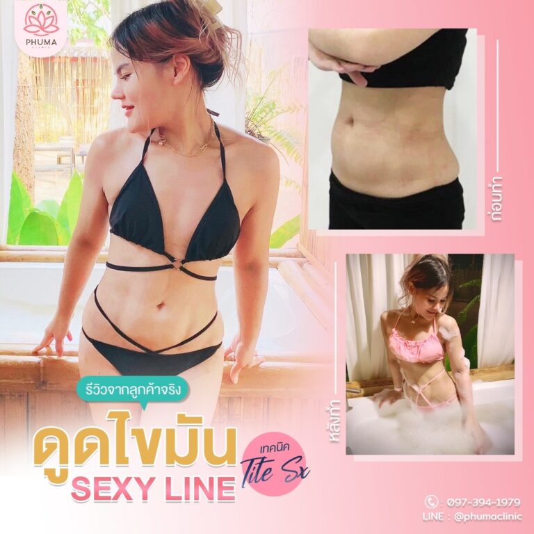 ดูดไขมัน phuma clinic พญ. ชลดา วิรัตกพันธ์ (หมอหนูใหม่)