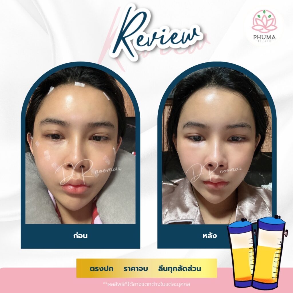 Phuma clinic (ภูม่า) พญ.ชลดา วิรัตกพันธ์ (ดูดไขมัน)
