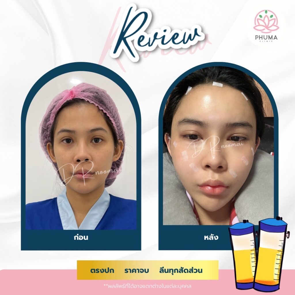 Phuma clinic (ภูม่า) พญ.ชลดา วิรัตกพันธ์ (ดูดไขมัน)
