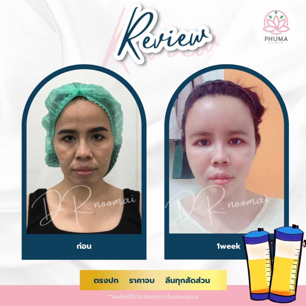 Phuma clinic (ภูม่า) พญ.ชลดา วิรัตกพันธ์ (ดูดไขมัน)