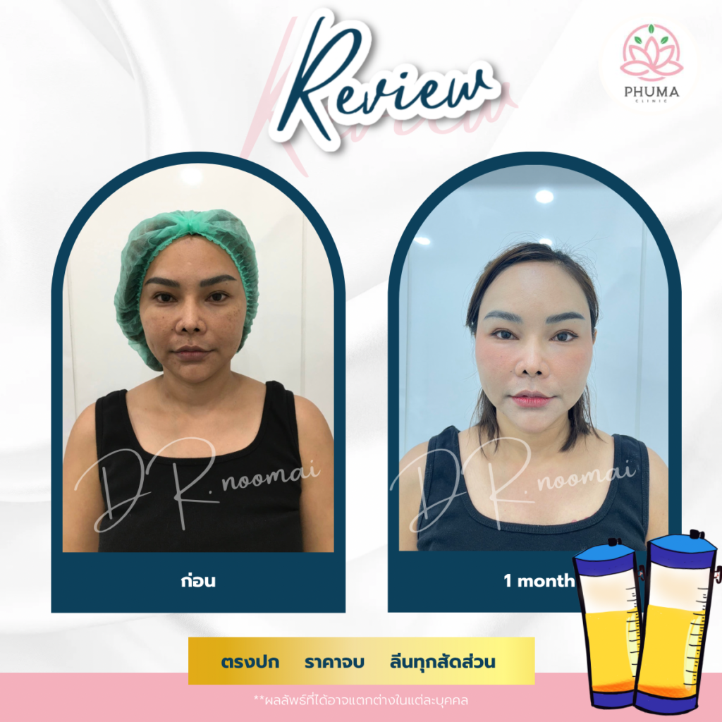 Phuma clinic (ภูม่า) พญ.ชลดา วิรัตกพันธ์ (ดูดไขมัน)