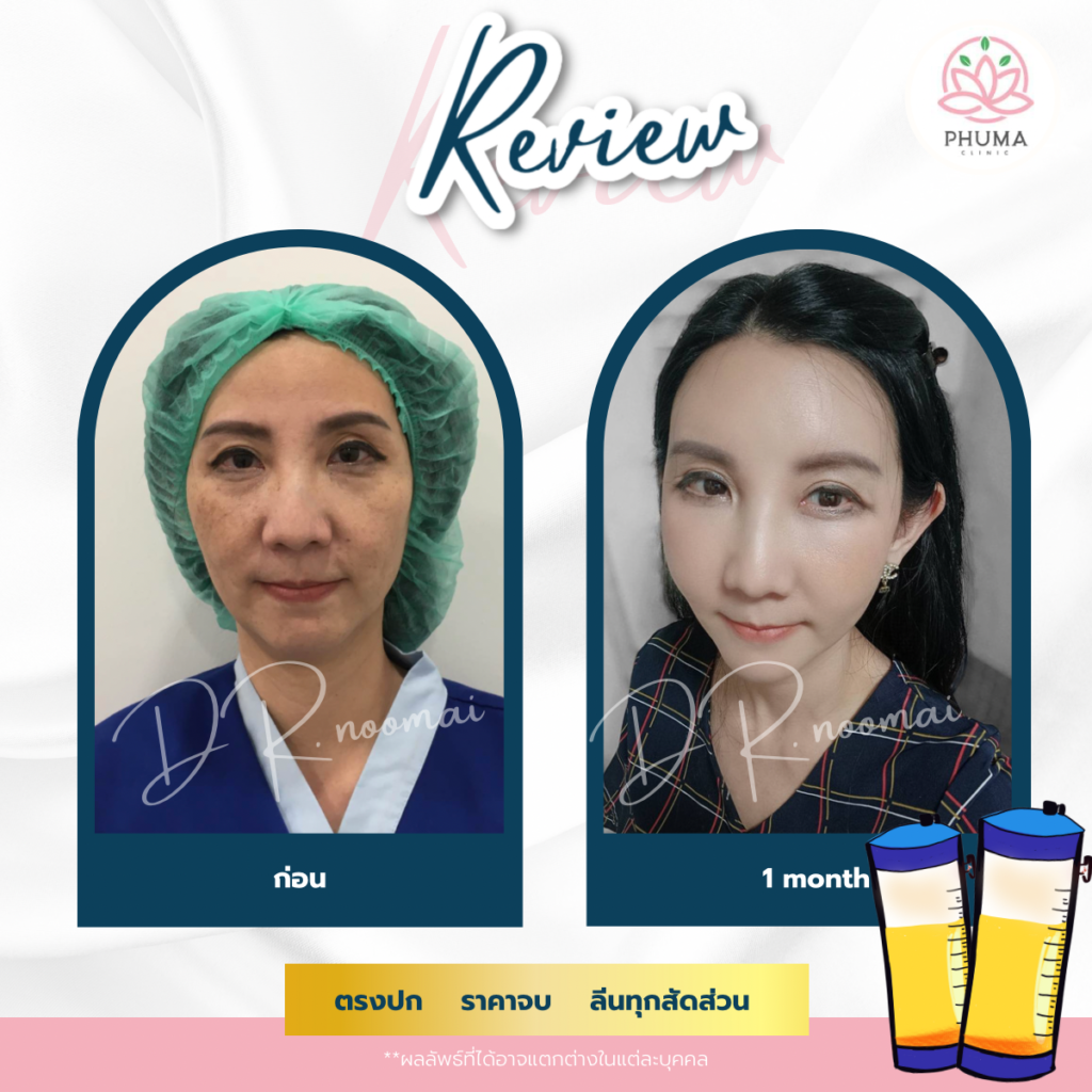 Phuma clinic (ภูม่า) พญ.ชลดา วิรัตกพันธ์ (ดูดไขมัน)