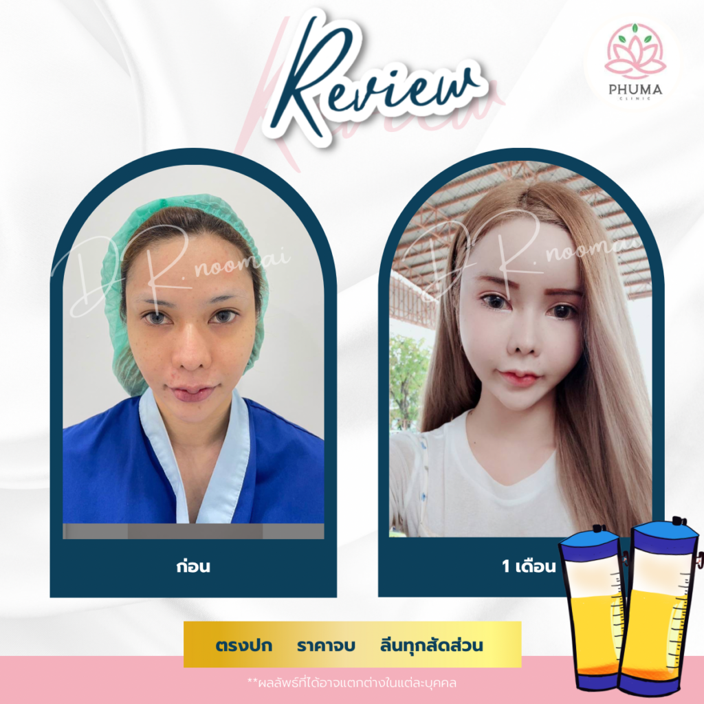 Phuma clinic (ภูม่า) พญ.ชลดา วิรัตกพันธ์ (ดูดไขมัน)