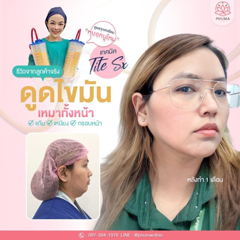 Phuma clinic (ภูม่า) พญ.ชลดา วิรัตกพันธ์ (ดูดไขมัน)