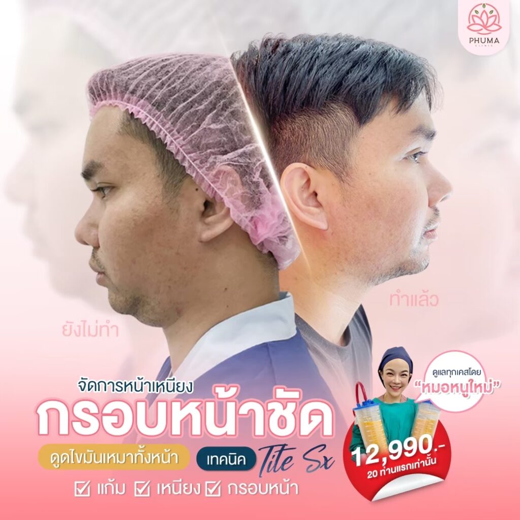 Phuma clinic (ภูม่า) พญ.ชลดา วิรัตกพันธ์ (ดูดไขมัน)