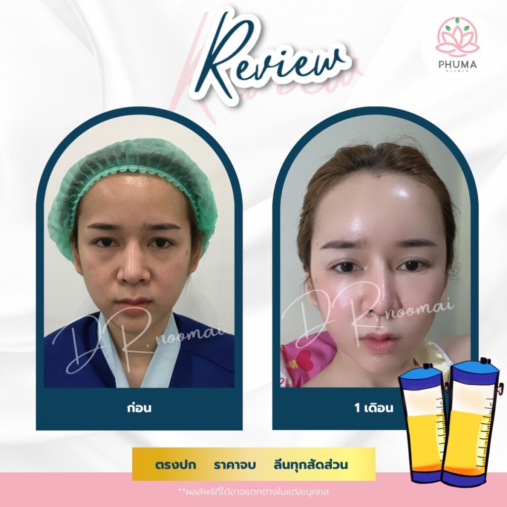 Phuma clinic (ภูม่า) พญ.ชลดา วิรัตกพันธ์ (ดูดไขมัน)