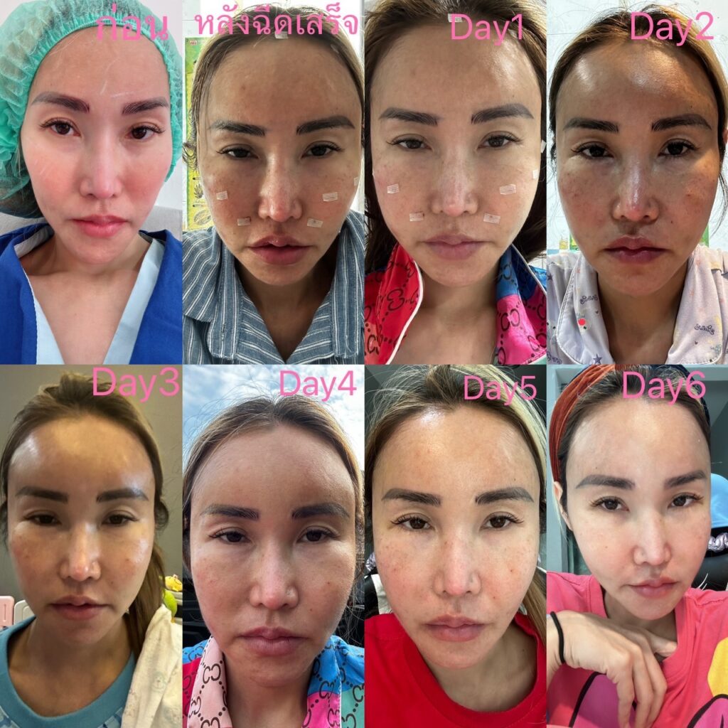 Phuma clinic (ภูม่า) พญ.ชลดา วิรัตกพันธ์ (ดูดไขมัน)