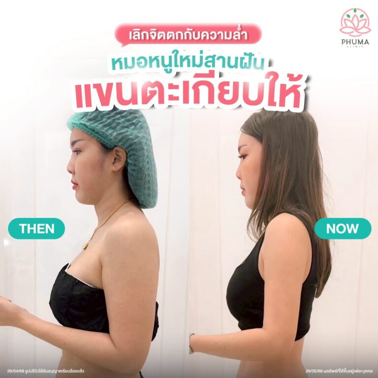 PHUMA CLINIC เป็นคลินิกที่ให้บริการ ดูดไขมัน เติมไขมันหน้า ลดสัดส่วน และปรับรูปหน้า ก่อตั้งโดย พญ.ชลดา วิรัตกพันธ์ (หมอหนูใหม่) แพทย์ผู้มีความชำนาญและมีประสบการณ์ยาวนานมากกว่า 10 ปี ประสบการณ์ทำทำเคสมามากกว่า 20,000 เคส